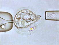 TE biopsy is performed